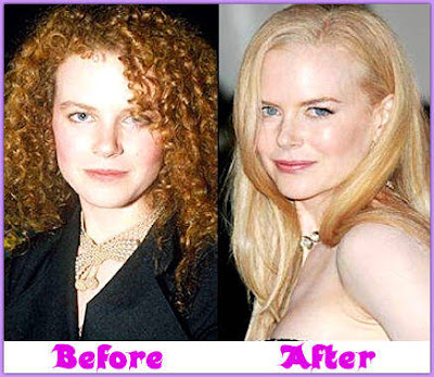 Nicole Kidman Plastic Surgery Before and After Botox, Lips and Breast