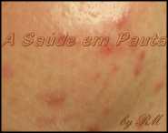A acne papulosa é a mais comum das afecções de acne