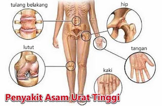 Nama Obat Asam Urat Alami, Penyebab Asam Urat Dan Pantangannya, Makanan Untuk Mencegah Penyakit Asam Urat, Obat Asam Urat Yang Bagus Apa, Cara Mengobati Asam Urat Dengan Lobak Putih, Obat Asam Urat Alami Nanas Lobak Kemiri, Asam Urat Kolesterol Dan Gula, Obat Asam Urat Dan Diabetes, Penyakit Asam Urat Gejalanya, Obat Asam Urat Air Kelapa, Ciri Penyakit Asam Urat, Efek Asam Urat Bagi Tubuh, Penyembuhan Asam Urat Akut, Cara Mengatasi Asam Urat Pada Tangan, Cara Mengatasi Asam Urat Parah, Cara Mengatasi Asam Urat Di Kaki, Ciri Penyakit Asam Urat Dan Pengobatannya, Nilai Asam Urat Dibawah Normal, Penyebab Asam Urat Rendah, Asam Urat Wortel, Obat Tradisional Utk Penyakit Asam Urat, Cara Mengobati Asam Urat Dg Alami, Alat Cek Gula Darah Kolesterol Asam Urat Yang Bagus, Tip Mencegah Penyakit Asam Urat, Asam Urat Sakitnya Dimana, 4life Transfer Factor Untuk Asam Urat, Cra Cepat Mengobati Asam Urat, Asam Urat Obat Herbalnya, Obt Asam Urat Generik, Cara Kerja Pemeriksaan Asam Urat Darah