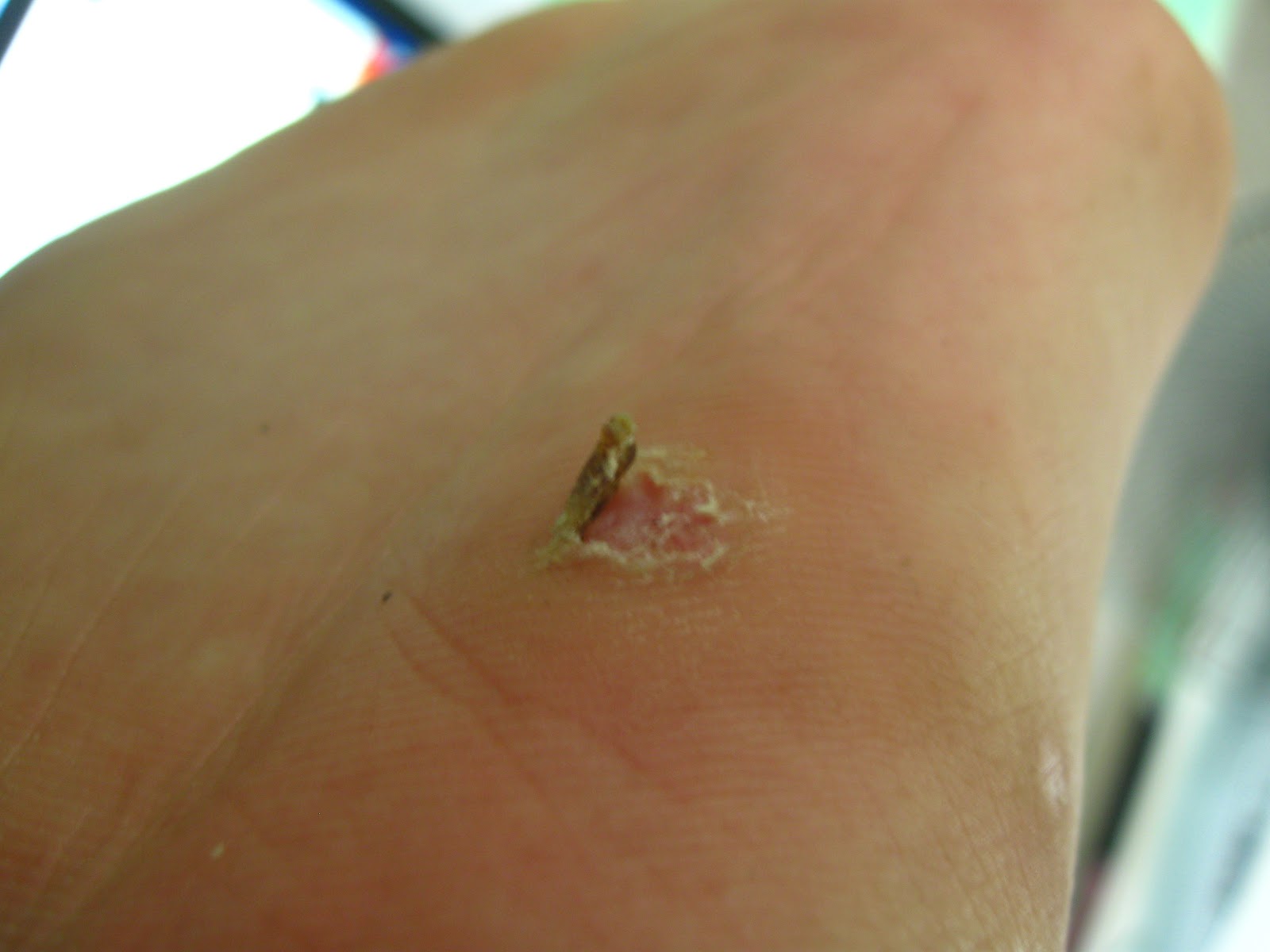 What To Do For A Planters Wart [+] Home Improvement