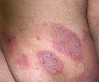 obat untuk penyakit kulit gatal eksim, mengobati penyakit eksim kering, gatal di selangkangan dan testis, obat herbal untuk penyakit gatal eksim basah, obat yang ampuh untuk penyakit gatal eksim, gatal di bokong anak, obat gatal kena jamur, obat gatal pada sela jari tangan, obat gatal bintik merah di badan, obat gatal di bawah kemaluan pria, foto eksim kering, obat gatal gatal bahan alami, obat herbal sakit kulit gatal eksim, obat gatal untuk ibu hamil 8 bulan, obat gatal eksim ringan, mengobati gatal eksim secara tuntas, cara pengobatan eksim kulit, gatal di bawah kemaluan pria, salep eksim basah di apotik, cara menghilangkan gatal didaerah kemaluan laki laki, nama obat tradisional gatal kulit, obat eksim basah pada anak, obat gatal resep dokter kulit, obat gatal untuk daerah kelamin pria, gatal eksim kering pada telapak kaki, obat gatal gatal di sela paha, gejala eksim kulit, obat gatal gatal kapsul, obat gatal d buah zakar, obat minum untuk gatal jamur