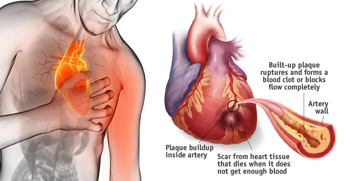 how-to-avoid-heart-attacks