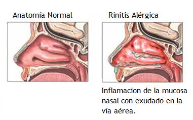 medicamento efectivo para la rinitis alergica