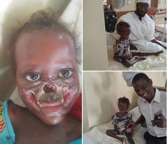 Photos: Little girl with severe facial disfigurement ...