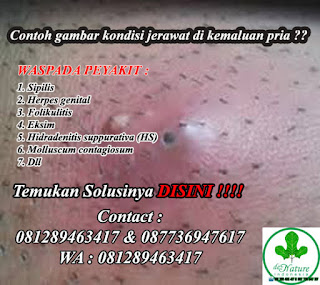 Image Cara mengobati bintik-bintik di sekitar miss v