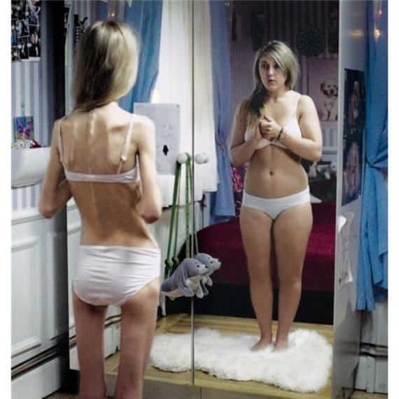 anorexia varicosei