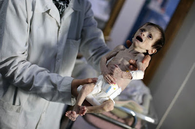 n Syria region under regime siege, children die of hunger n Syria region under regime siege, children die of hunger