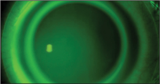 Contact Lens Update Synergeyes Duette Eyedolatry