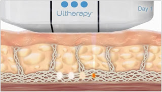 ultherapy