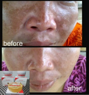 Cream Wajah Penghilang Kokoloteun Liyoskin Cream Wajah Penghilang Kokoloteun