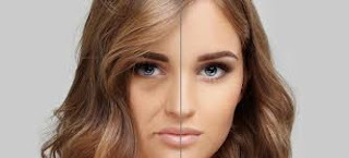 Nasolabial Folds Corrections Using Juvederm Juvederm Edmonton