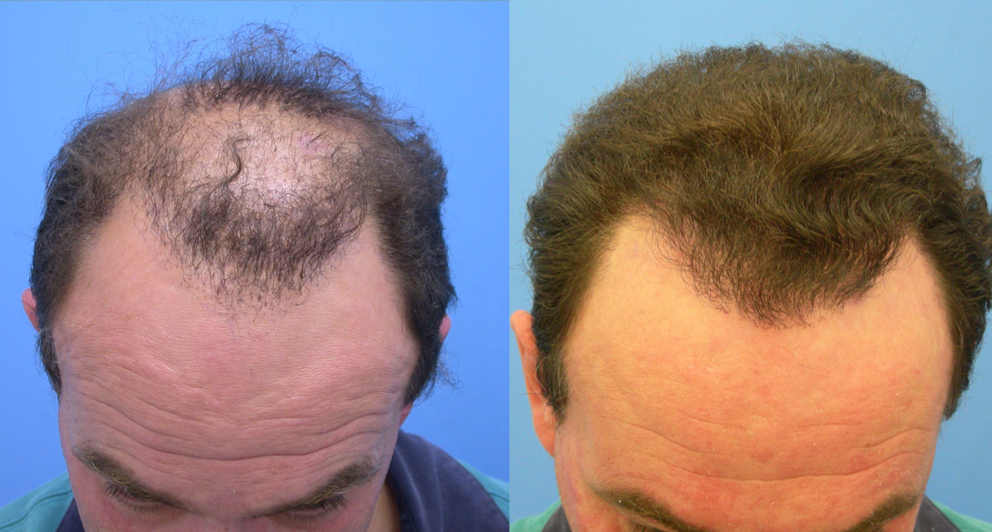 Рост волос на лице у мужчин. Редкие волосы у мужчин. Трансплантация волос fue. Прическа для пересадки волос.