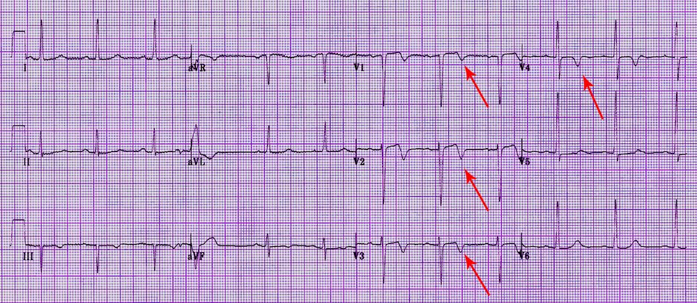 инверсия зубца t. синдром велленса на экг. синдром wellens на экг. Wellens на экг. синдром wellens на экг.