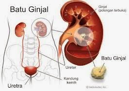 Obat untuk Menghancurkan Batu Ginjal dan Batu Empedu