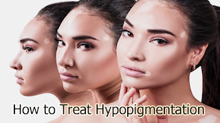 How to Treat Hypopigmentation