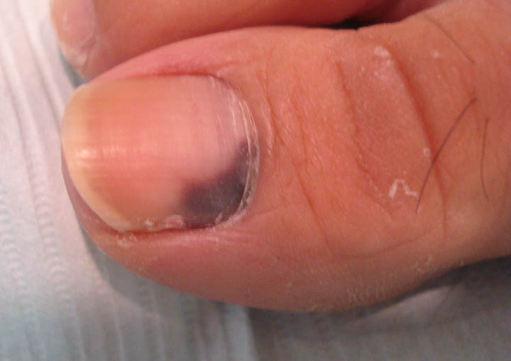 What Is a Toenail Melanoma? (with pictures) - wiseGEEK