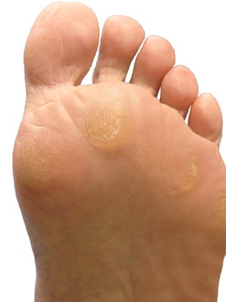 pictures of calluses on foot #9
