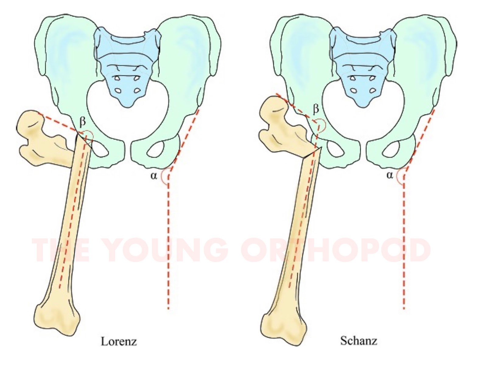 Both Lorenz and Schanz osteotomies provide 'pelvic support'. Milch