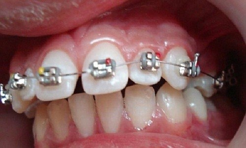 CHÌA 2 RĂNG CỬA ĐIỀU TRỊ CÁCH NÀO TỐT NHẤT -4