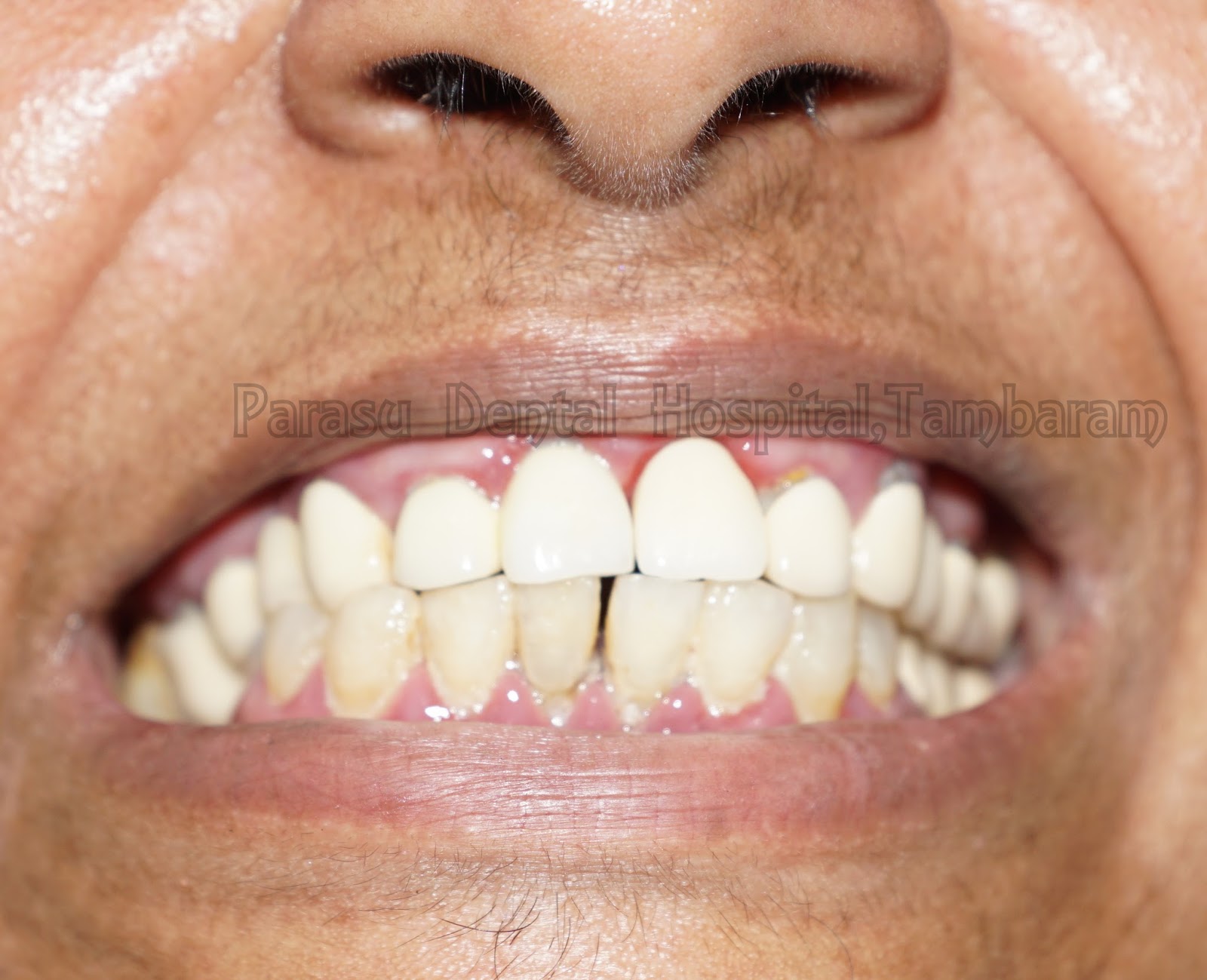 Dental Xray center in medavakkam Laser root canal with zirconium crown