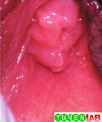 Typical appearance of the hymen and perihymenal tissues in a 12-year-old girl Typical appearance of the hymen and perihymenal tissues in a 12-year-old girl