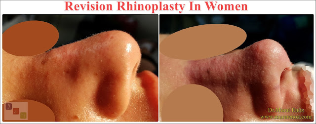 Revision Nose Job Surgery For Women in Istanbul - Revision Female Rhinoplasty in Istanbul - Women's Revision Rhinoplasty in Turkey - Revision Nose Reshaping For Women in Istanbul - Revision Nose Job Rhinoplasty For Women in Istanbul - Best Revision Rhinoplasty For Women Istanbul - Revision Nose Aesthetic For Women in Istanbul - Female Revision Nose Operation in Istanbul - Female Revision Rhinoplasty Surgery in Istanbul - Female Revision Rhinoplasty Surgery in Turkey - Female Revision Nose Aesthetic Surgery in Istanbul - Revision Rhinoplasty In Women Istanbul