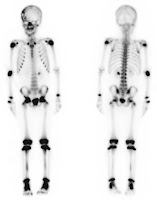 A figure from Intermediate Physics for Medicine and Biology showing a bone scan obtained using a scintillation camera.