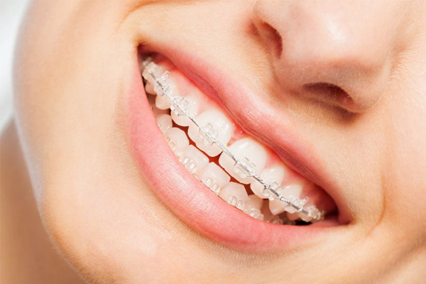 Orthodontist for clear ceramic braces in Heidelberg, Rosanna, Ivanhoe, Eaglemont & Macleod
