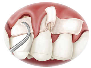  Directives concernant les greffes gingivales