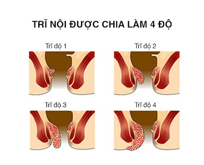 cac cap do cua benh tri noi