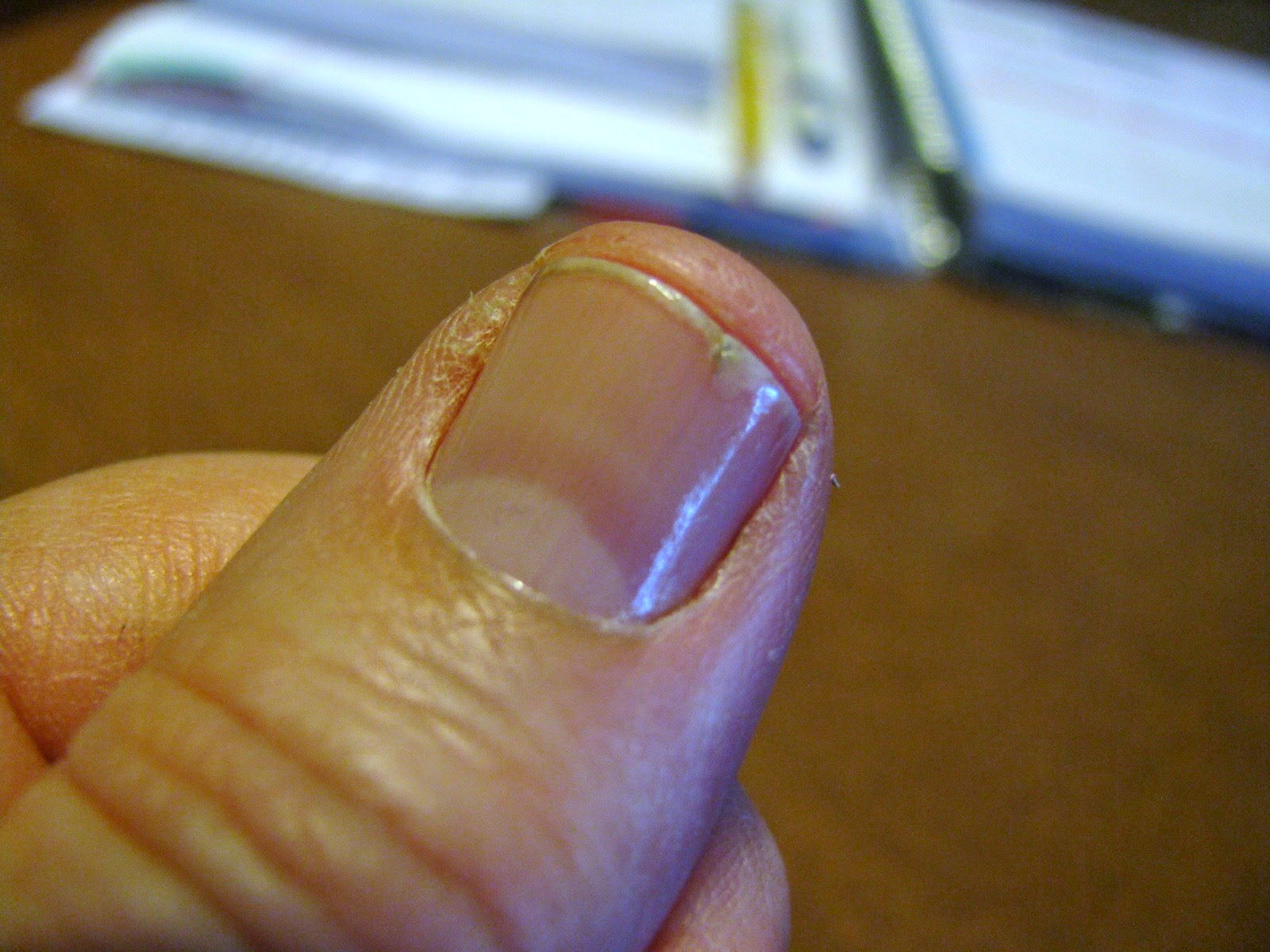 The Cannary Family The nail issue is starting to trouble me