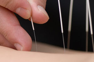 Acupuncture and Rheumatoid Arthritis