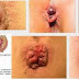 Penyembuhan pada penyakit ambeien ST 4 thumbnail