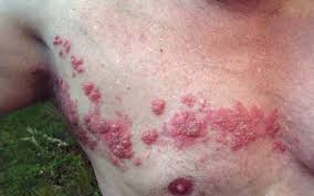 Bagaimana Cara Mengobati penyakit Herpes Secara Total Bagaimana Cara Mengobati penyakit Herpes Secara Total