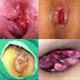 Obat Salep Manjur Kempeskan Benjolan Wasir di Bokong thumbnail