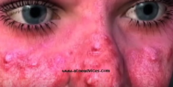 What is the main difference between acne vulgaris and acne rosacea