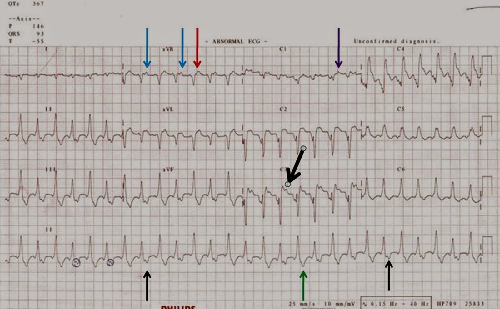 Dr. Smith's ECG Blog Chest pain, SOB, and tachycardia. What is the