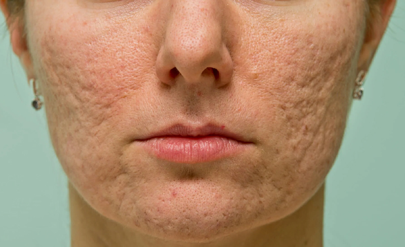 Acne Scars Causes of Dark Skin Pigmentation