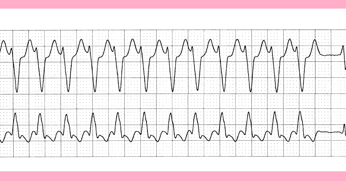 ekg-strips-flashcards-ekg-dysrhythmias-studyblue-amandaazer