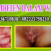 Cara Mengobati Wasir Berdarah Dengan Bawang Putih thumbnail