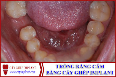 trồng răng cấm bằng phương pháp cấy ghép Implant -1 trồng răng cấm bằng phương pháp cấy ghép Implant -1