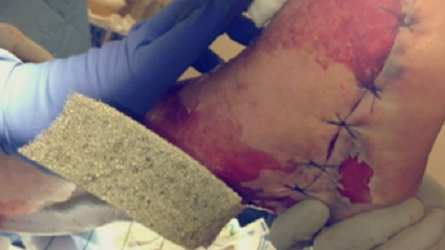 After Reading This You Will Never Get a Pedicure Again : Woman Gets a Life-Threatening Infection After Pedicure After Reading This You Will Never Get a Pedicure Again : Woman Gets a Life-Threatening Infection After Pedicure