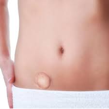 Obat Hernia Tradisional Menyembuhkan Tanpa Operasi Obat Hernia Tradisional Menyembuhkan Tanpa Operasi