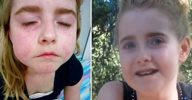 Little Girl Cures Herself Of Arthritis And Lupus By Eliminating These 3 Things From Her Diet
