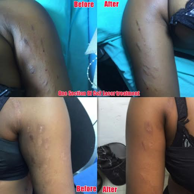 bleaching stretch marks