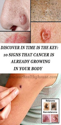 DISCOVER IN TIME IS THE KEY: 10 SIGNS THAT CANCER IS ALREADY GROWING IN YOUR BODY