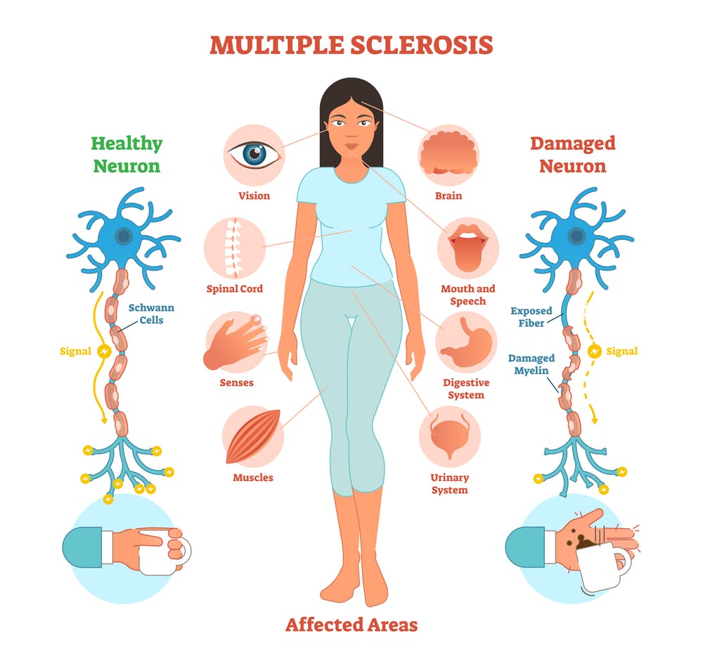 Mareos calambres musculares olvidadizos