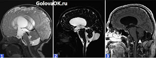 МРТ снимок головного мозга пациента с кистой кармана Блейка