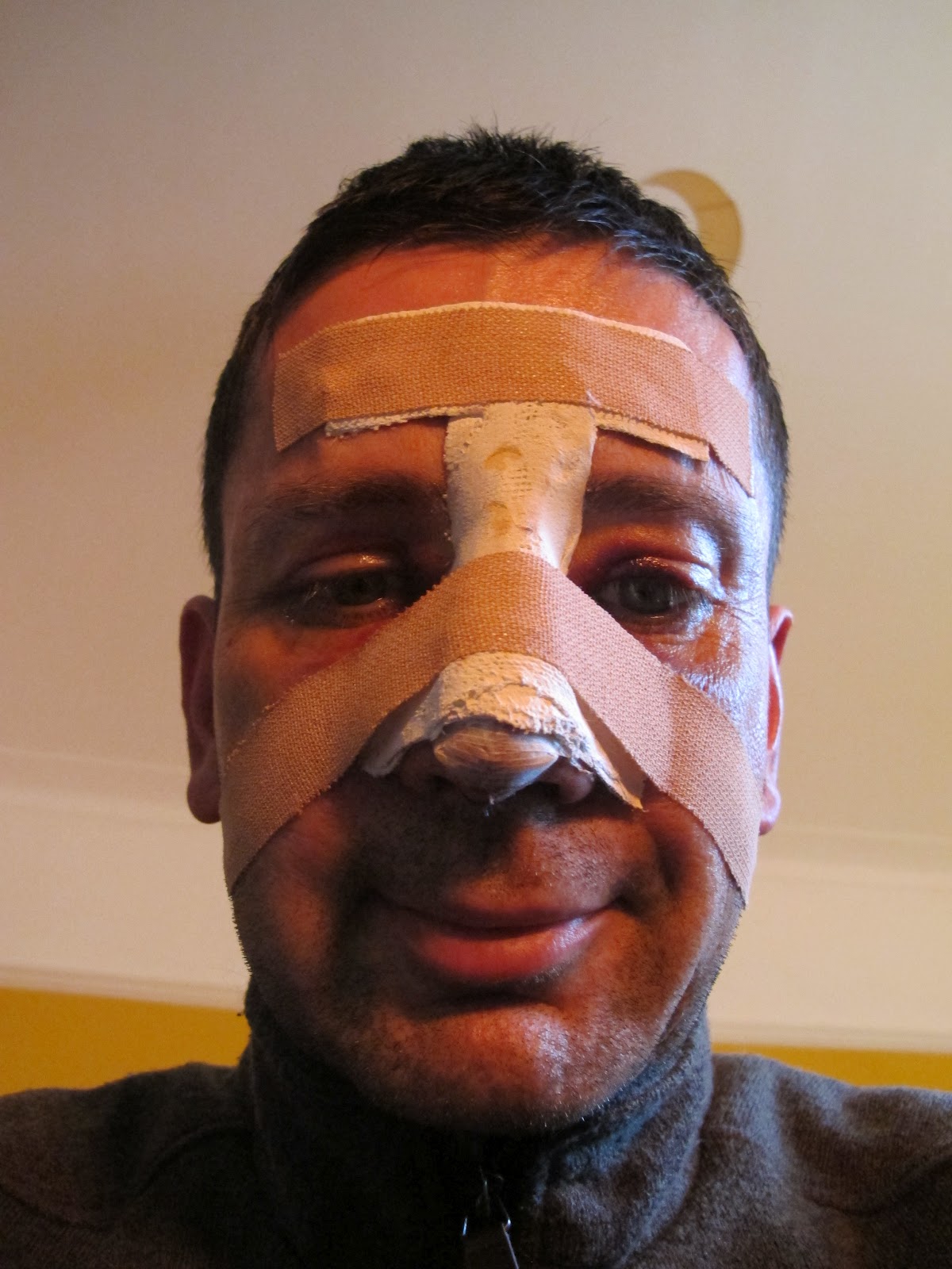 extracorporeal-septoplasty-recovery-blog