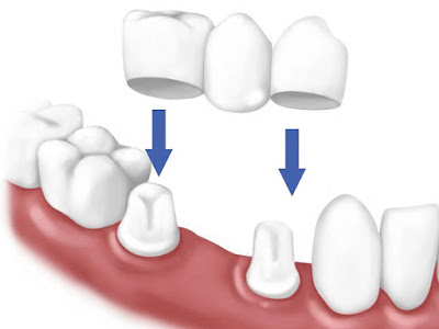  Thông tin về cầu răng sứ bạn cần biết